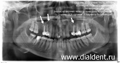 панорамный снимок зубов для ЛОР-диагностики