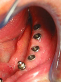 имплант зуба
