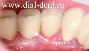 протезирование зубов после удаления десны