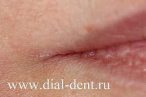 после 2-й процедуры лечения лазером трещин в уголках губ