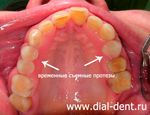 временные зубные протезы