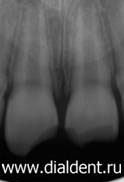 рентген зубов, травма передних зубов