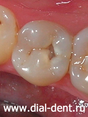 дырка в зубе - кариес