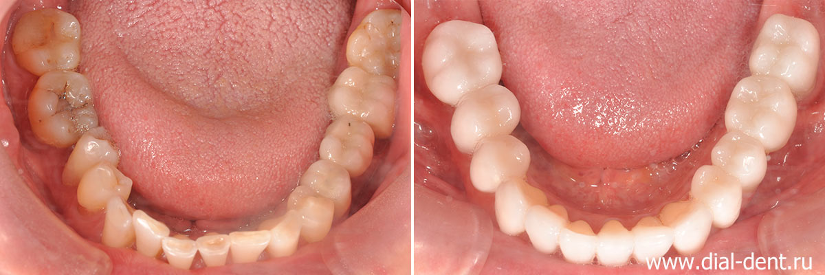 вид нижних зубов до и после протезирования керамикой