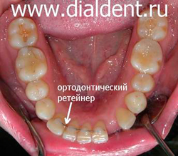 ортодонтическое лечение перед протезированием
