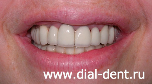 лечение каналов, комбинированное протезирование зубов