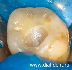 пломбирование устьев каналов зуба