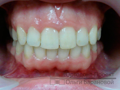 исправление прикуса и выравнивание зубов брекетами Инкогнито