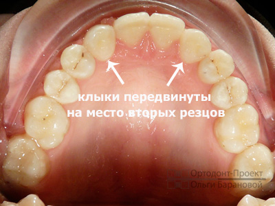 щели между зубами закрыты
