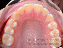 результат ортодонтического лечения, ортодонт Селектор О.Н.