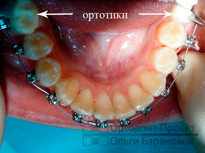 несъемный ортотик зафиксирован на зубах