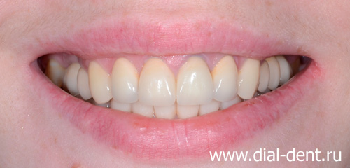 улыбка после лечения и протезирования зубов