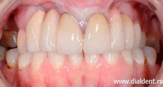 протезирование зубов после операции по поводу расщелины губы и неба