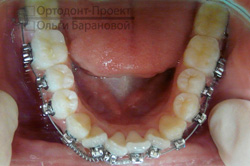 брекеты установлены на зубы нижней челюсти