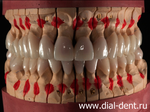керамические зубные коронки на модели
