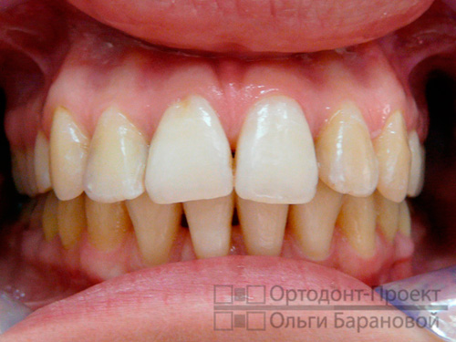 проведено ортодонтическое лечение глубокой окклюзии