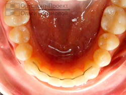 после ортодонтического лечения - фото нижних зубов