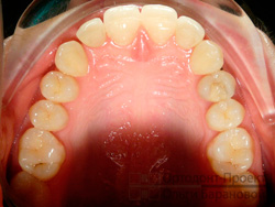после ортодонтического лечения и протезирования - фото верхних зубов