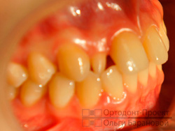 фото до лечения у ортодонта - справа