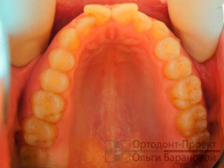 до ортодонтического лечения - верхняя челюсть