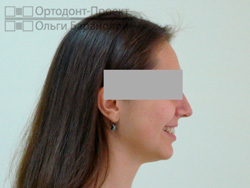 вид в профиль после ортодонтического лечения