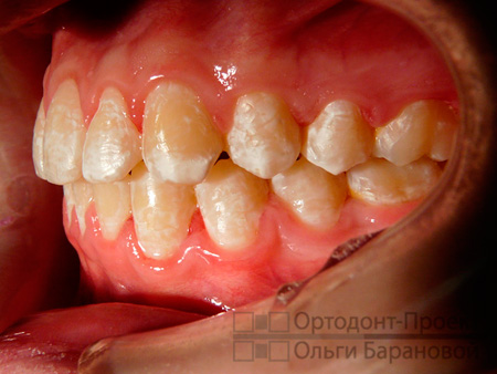 окончание лечения, контакты между зубами плотные