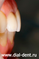 протезирование зубов коронками из диоксида циркония в "Диал-Дент"