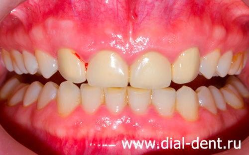 воспаление десен, металлокерамика на передних зубах