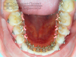этап ортоэластиков - нижняя челюсть