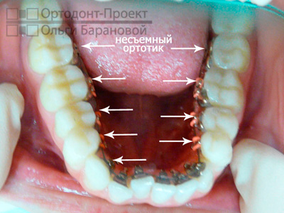 несъемный ортотик - вид на зубах