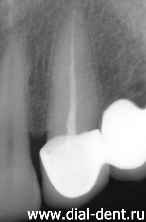 рентген зуба
