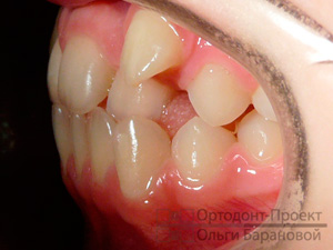 до лечения у врача-ортодонта