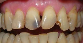 передние зубы до лечения