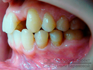 результат ортодонтического лечения слева