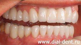 вид справа после протезирования зубов