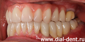 результат комплексного протезирования зубов в Диал-Дент - вид слева