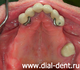 верхняя челюсть с протезом передних зубов