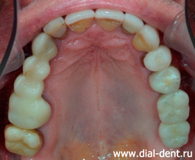 протезирование металлокерамикой - верхние зубы