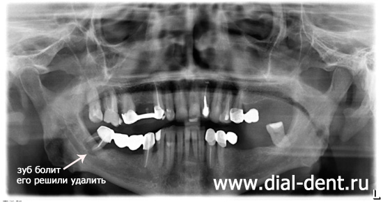 панорамный снимок зубов до лечения и имплантации зубов