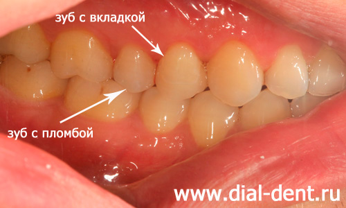 лечение кариеса и восстановление зубов