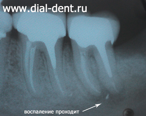 рентген зубов после лечения