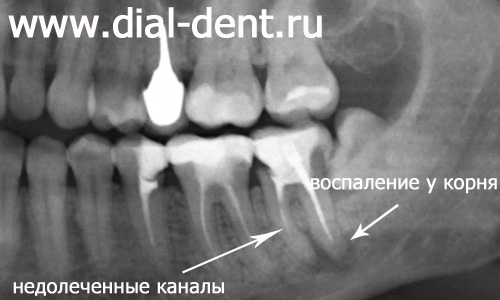 панорамный снимок зубов (фрагмент) до лечения