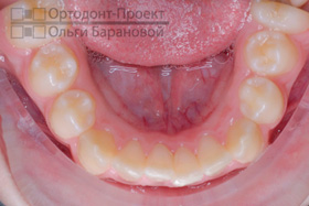 нижняя челюсть до ортодонтического лечения