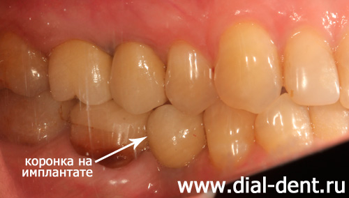 протезирование на имплантах зубов