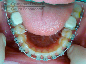 брекеты Clarity-SL - нижние зубы через 4,5 месяца