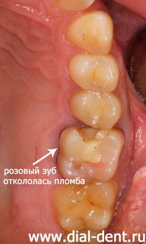 старые пломбы в резорциновом розовом зубе