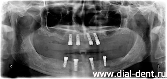 панорамный снимок зубов после приживления зубных имплантов