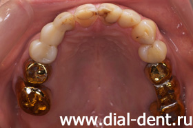 старые зубные коронки, больные зубы и десны - верхняя челюсть
