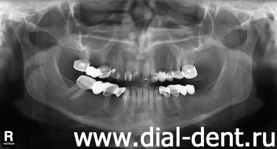 панорамный снимок зубов (ортопантомограмма) до лечения