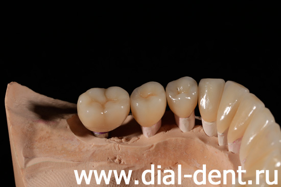 коронки керамические изготовлены в семейной стоматологии Диал-Дент